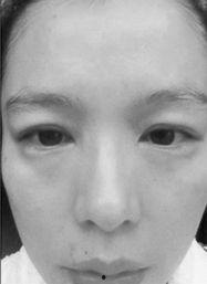 明星脸过敏肿,揭秘明星相似度背后的风险与应对策略